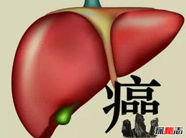 肝癌發(fā)病率最高的國(guó)家排名 埃及榜上第四,第一酒精過(guò)度依賴