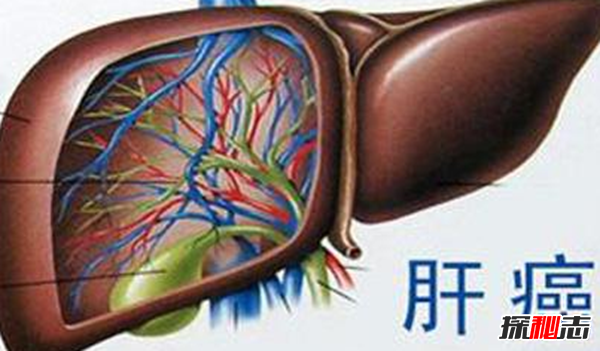肝癌發(fā)病率最高的國(guó)家排名 埃及榜上第四,第一酒精過(guò)度依賴