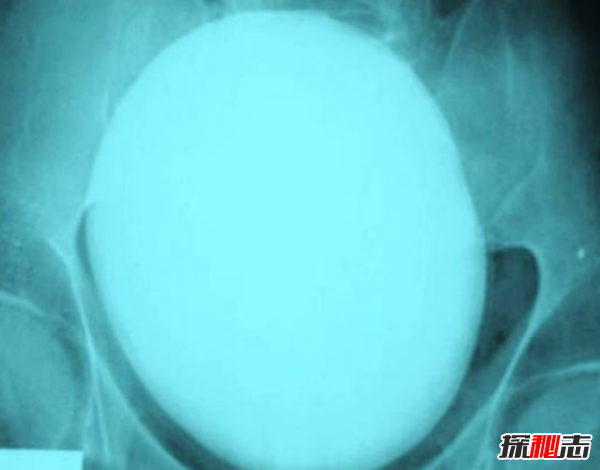 x光片發(fā)現(xiàn)十大最恐怖的東西,你絕對想不到居然有它